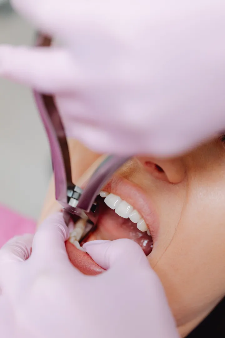 A dental procedure in progress, showing a close-up of a patient's open mouth and a dentist's gloved hands using forceps to extract a tooth