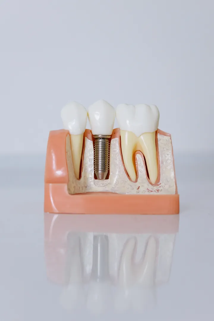 Why Dental Implants Are the Best Solution for Missing Teeth