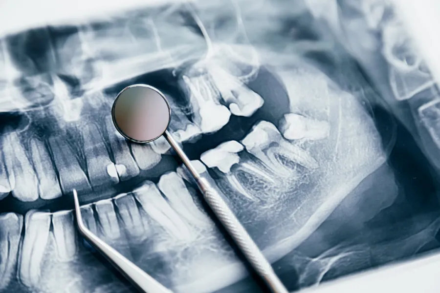 Is Wisdom Teeth Removal Necessary? Here’s What Experts Say